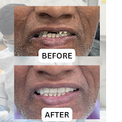 Before and after dental treatment result - unnamed (3).png
